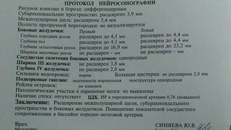 Расширение желудочков у новорожденного