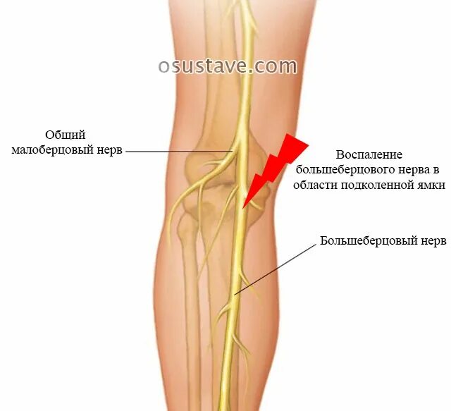 Болит под коленом что это может быть. Клиновидный нерв коленного сустава. Защемление большеберцового нерва. Большеберцовый нерв в подколенной ямке. Малоберцовый нерв в подколенной ямке.