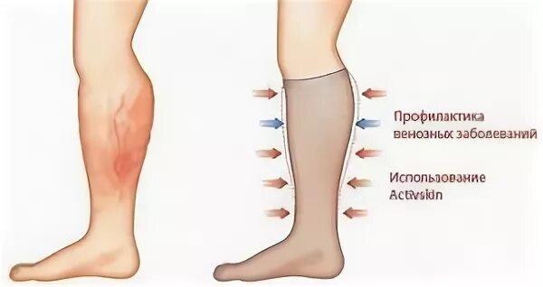 Тромбоз конечностей код по мкб 10. Тромбоз глубоких вен нижних конечностей мкб 10. тромбоз вен нижних конечностей код мкб. тромбоз глубоких вен нижних конечностей код по мкб 10. тромбофлебит вен нижних конечностей мкб 10 код.