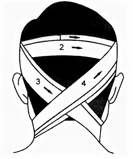 Техника наложения крестообразной повязки. Крестообразная повязка алгоритм. Техника наложения крестообразной повязки на затылок. Крестообразная повязка на затылок и шею. Крестообразная на затылок бинтовая повязка.