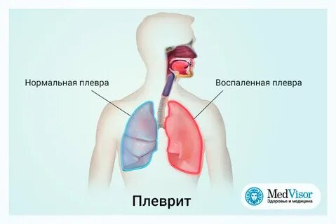 Боль в легких при вдохе