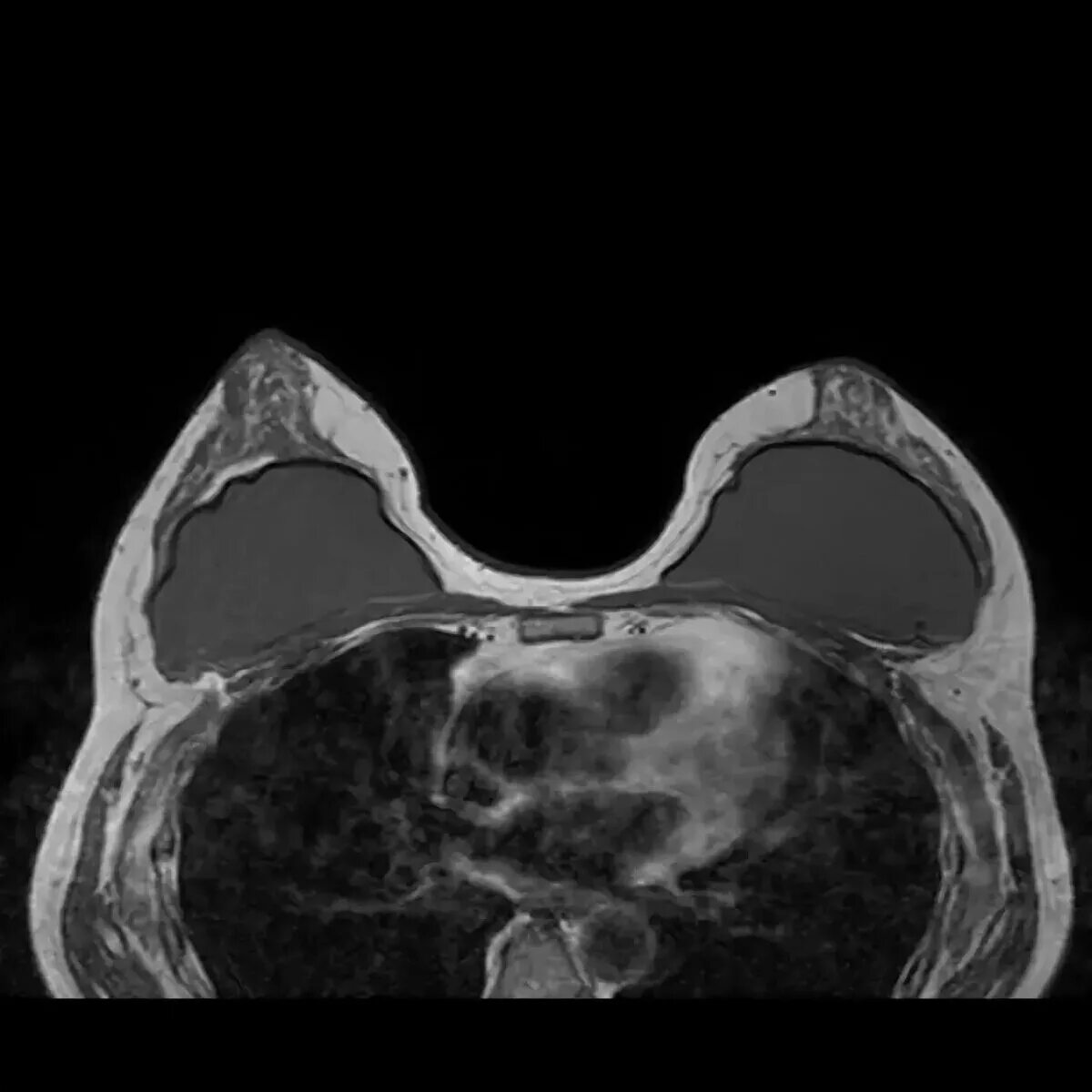 Имплант и мрт можно ли. Капсулярная контрактура мрт. Капсулярная контрактура грудного импланта мрт. Контрактура импланта мрт. Капсулярная контрактура импланта на УЗИ.