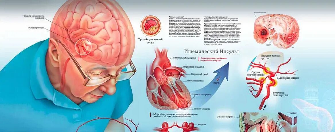 Ишемия головного мозга у пожилых людей