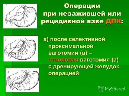 Дренирующие операции на желудке
