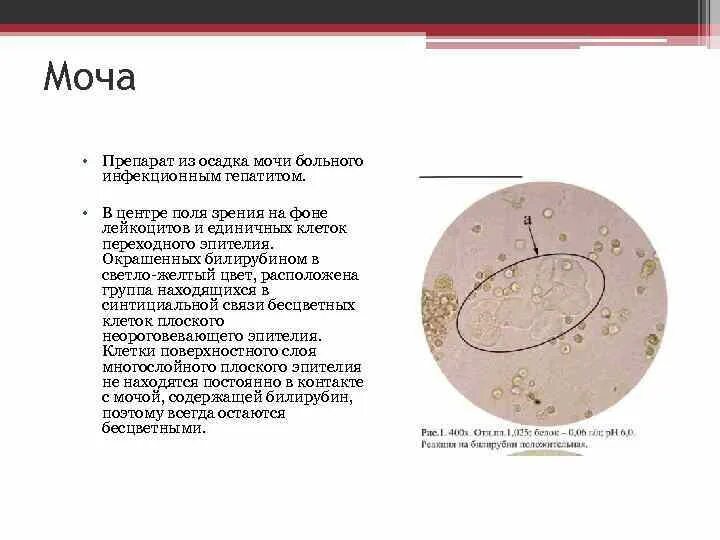 Организованные осадки мочи. Осадок мочи. Микроскопия окрашенного осадка мочи. Окрашенный осадок мочи. Моча при раке мочевого