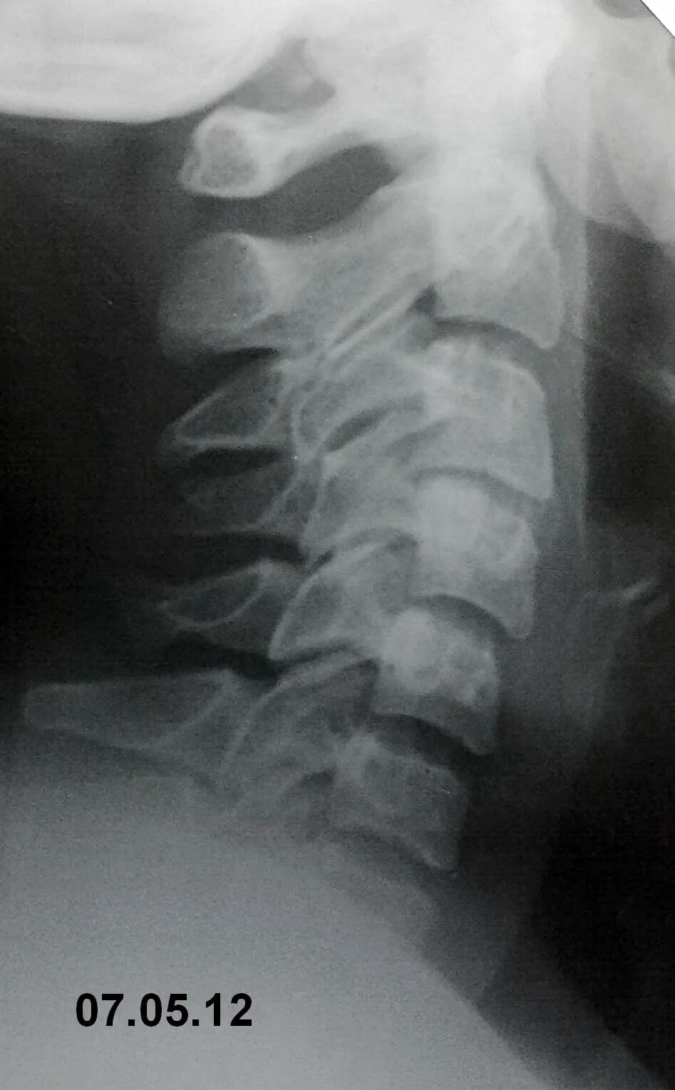 Артроз унковертебральных сочленений рентген. Артроз унковертебральных сочленений шейного отдела позвоночника. Дугоотросчатые суставы позвоночника рентген. Унковертебральный артроз шейного отдела кт. Артроз унковертебральных суставов.