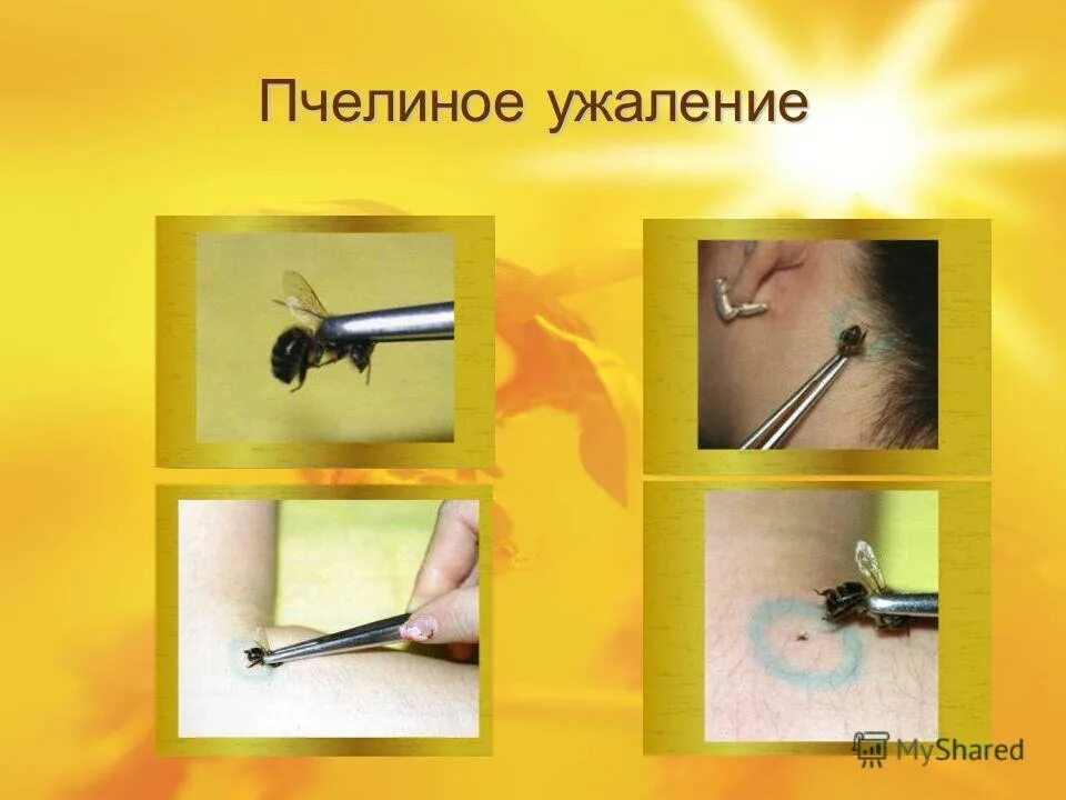 Как получить жало. Как получить жало