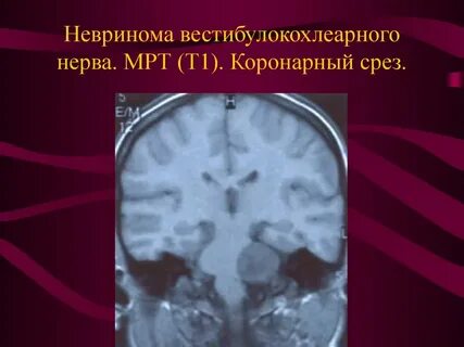 Невринома нерва