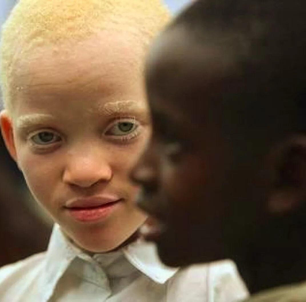 Что самое белое в черных людях. Альбинизм негроидная раса. Глазокожный альбинизм. Монголоиды альбиносы. Альбинос негроидной расы.