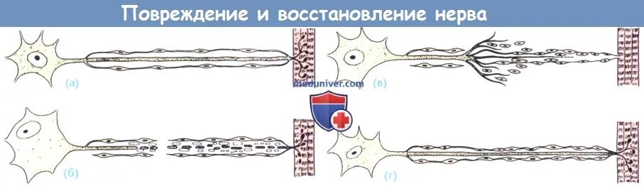 Восстановление нервов после операции. Регенерация нерва. Регенерация нервов.