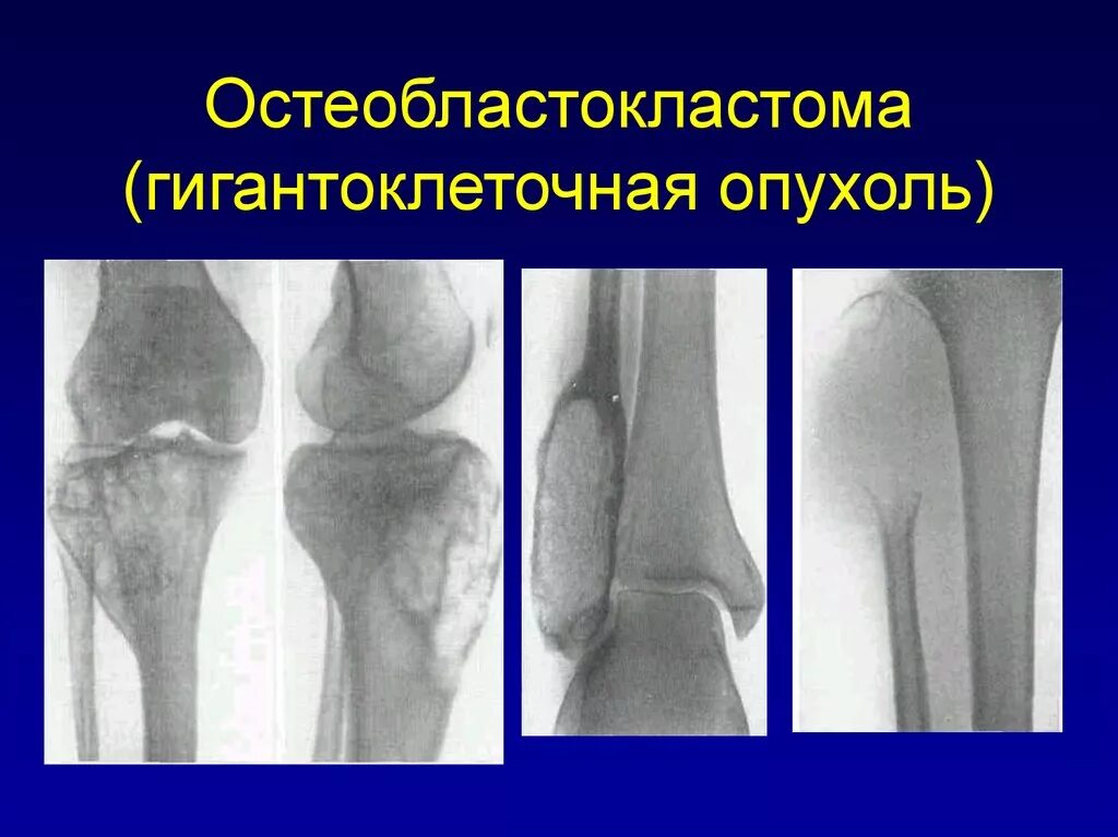 Гигантоклеточная опухоль лечение. Гигантоклеточная опухоль большеберцовой кости рентген. Гигантоклеточная опухоль бедренной кости рентген. Гигантоклеточная опухоль лечение. Гигантоклеточная опухоль плечевой кости.