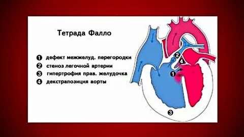 Врожденный порок аорты