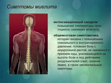 Острый поперечный миелит