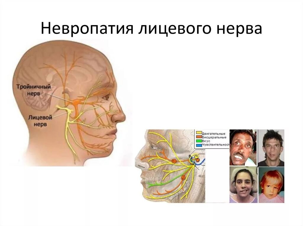 Невропатия тройничного нерва анатомия. Невропатия (неврит) лицевого нерва.. Неврит невропатия тройничного нерва. Лицевой нерв и тройничный нерв. Левый лицевой нерв