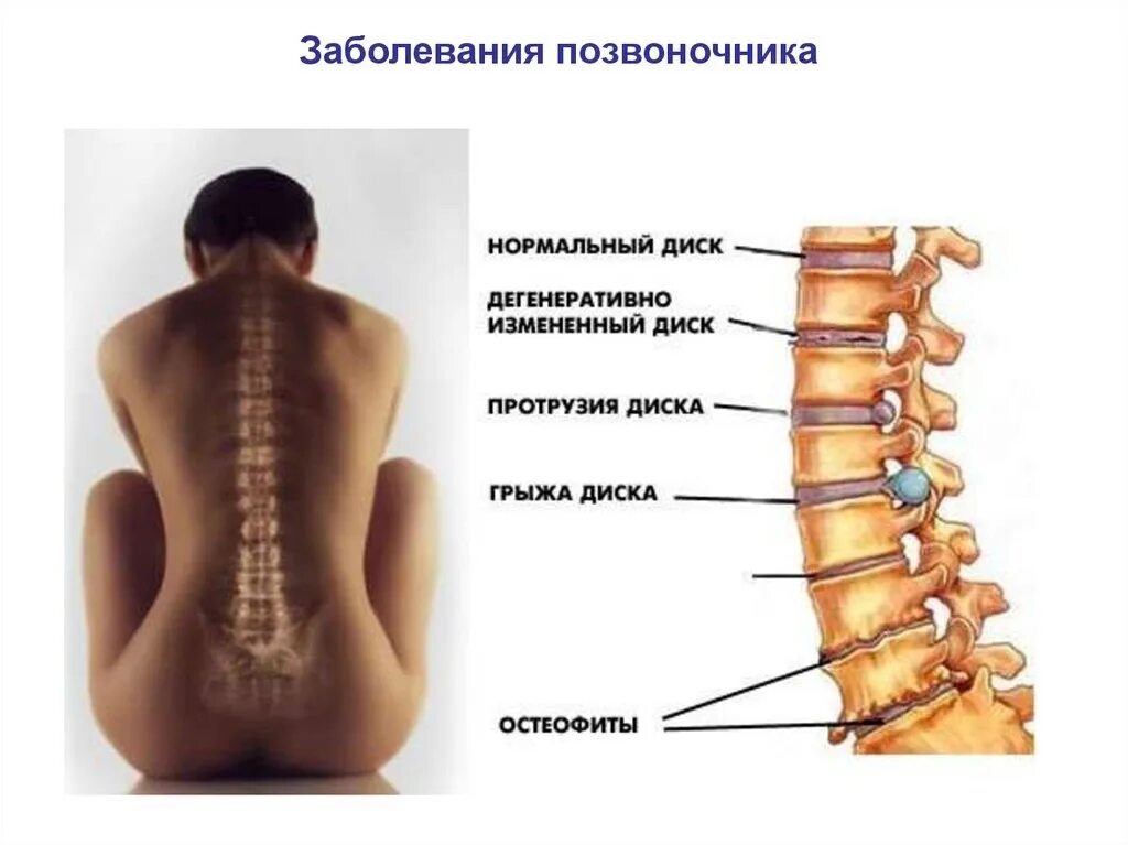 Показать поясницу. Позвоночник. Позвоночник картинки. Грыжа позвоночника. Грыжа позвонка.