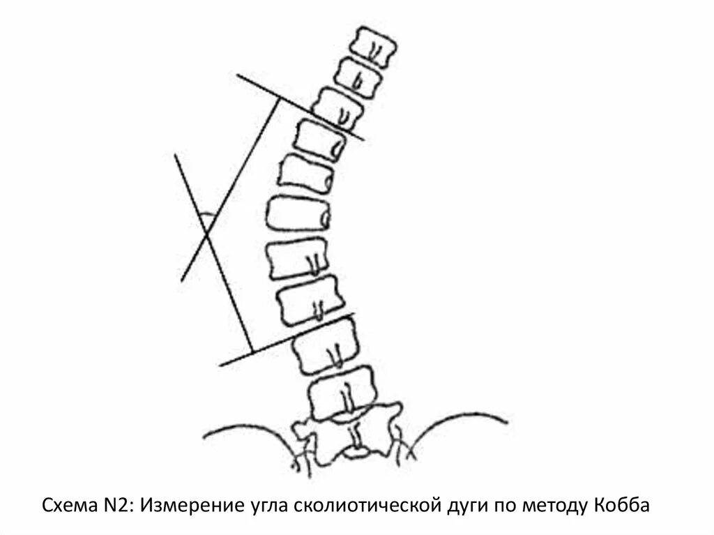 Метод Кобба сколиоз позвоночника. Угол сколиоза метод Кобба. Сколиоз позвоночника угол Кобба. Метод Кобба сколиоз степени. Угол кобба