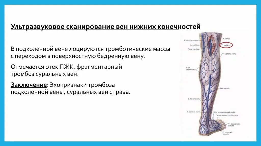 Карта вен нижних конечностей. Подколенная Вена тромбоз. Тромбофлебит подколенной вены. Тромбоз глубоких вен нижних конечностей. Заключение вены нижних конечностей.