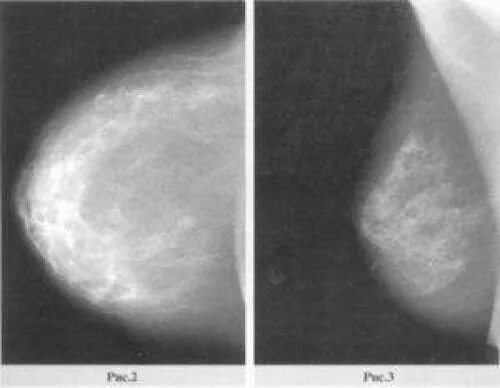 Маммография жировая инволюция. Фиброзная инволюция молочных желез. Фиброзно-кистозная мастопатия рентген. Жировая инволюция молочных желез на УЗИ. Диффузно фиброзные изменения молочных желез