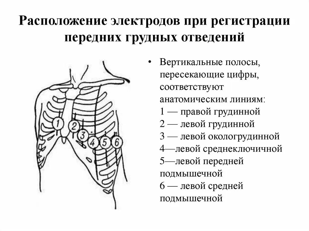 Как ставить электроды. Схема расположения электродов при экг. схема накладывать электроды экг. электроды экг схема наложения электродов. схема наложения электродов при холтеровском мониторировании экг.