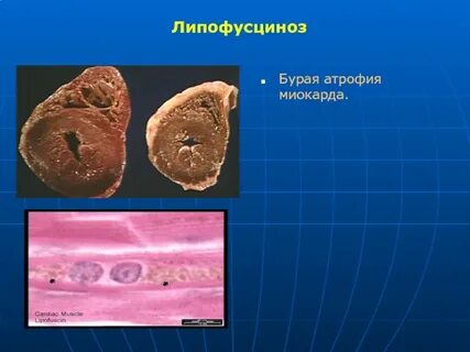Бурая атрофия