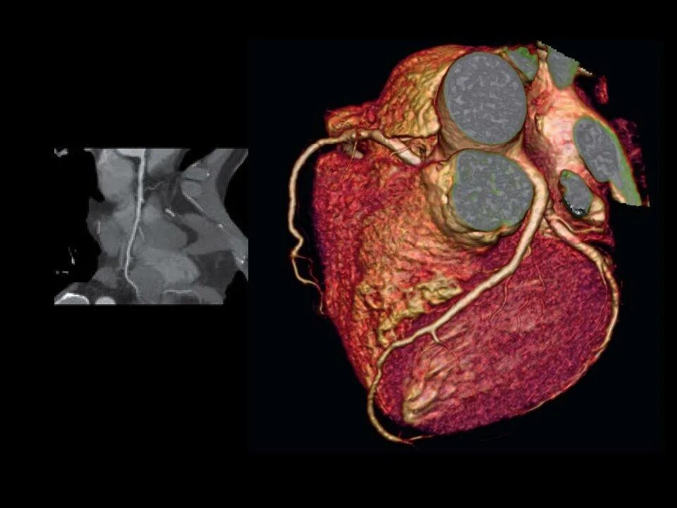 Сердечно-сосудистая система человека. Кровеносные сосуды человека. Сосуды сердца. Селективная коронарная ангиография. Страдает сердечно-сосудистая система.