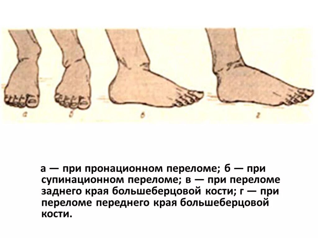 Растяжение голеностопного сустава карта. Пронационно-абдукционные переломы лодыжек. закрытый перелом голени карта вызова. пронационный и супинационный перелом лодыжек. супинационные переломы лодыжек.