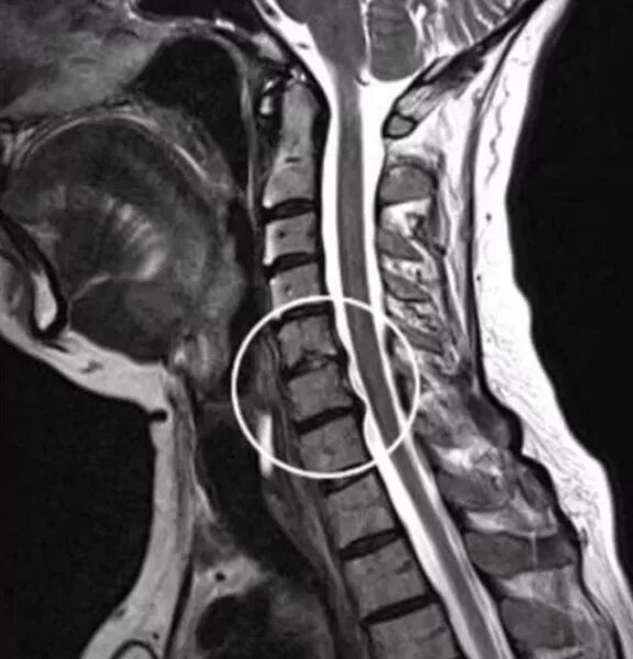 Снимки мрт шейного отдела. Шейные позвонки мрт. Остеохондроз шейного отдела мрт снимки. Шейный остеохондроз на мрт.
