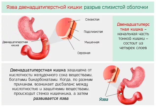 Язву 12 перстной вылечил. Терапия язвенной болезни 12 перстной кишки. язвенная болезнь 12 перстной кишки кишки. язвенная болезнь 12 перстной кишки специфические симптомы. питание для больных с язвой 12 перстной кишки.