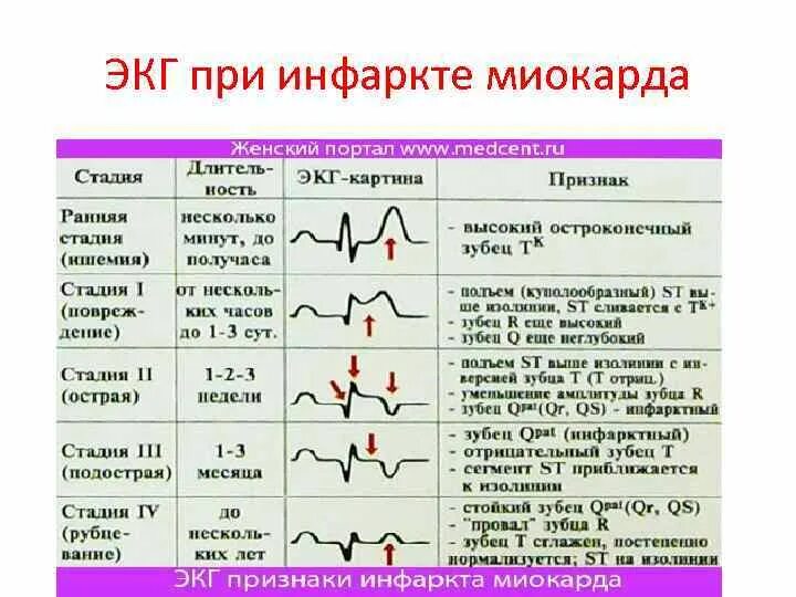 Показатели давления при инфаркте миокарда. Показатели ад при инфаркте миокарда. Артериальное давление при остром инфаркте миокарда. Периоды инфаркта миокарда ЭКГ изменения. Симптомы микроинфаркта у женщин