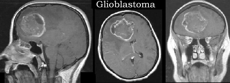 Глиобластома головного мозга. Доброкачественная глиобластома. Глиобластома 4 степени.