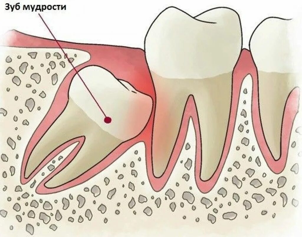 Лечение зуба 8. Альвеолит зуба мудрости. Ретинированный зуб мудрости. Перикоронит зуба мудрости.