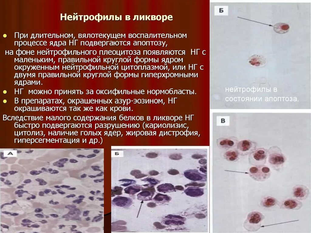 Эритроциты макрофаги. Лимфоциты и нейтрофилы в ликворе. Нейтрофилы в ликворе микроскопия. Микроскопия ликвора в норме. Нейтрофильный цитоз в ликворе.