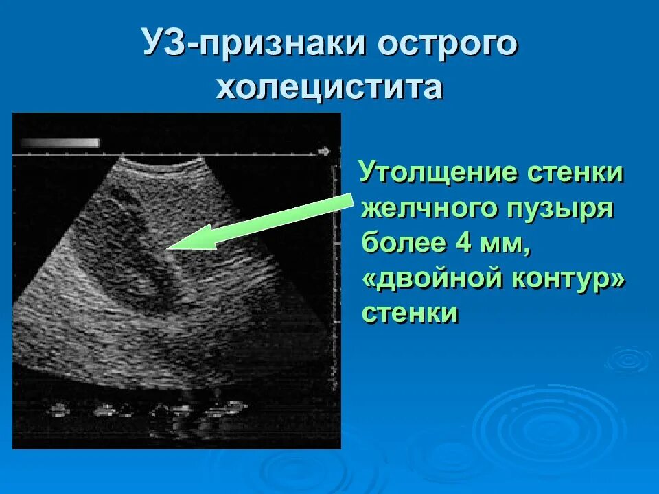 Эхопризнаки желчного пузыря. УЗИ критерии острого холецистита. УЗИ признаки камней в желчном пузыре. Острый калькулезный холецистит на УЗИ. Желчный острый холецистит на УЗИ.