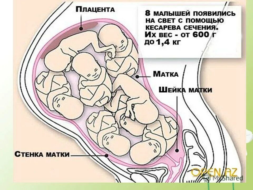 Сколько человек в животе. Положение ребенка в животе. Расположение ребенка в животе. Расположение двойняшек в животе.