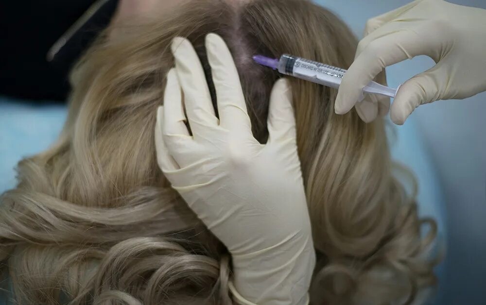 Мезотерапия месячных. Мезотерапия для волос. мезотерапия кожи головы. мезотерапия волосистой части головы. мезотерапия волос головы.