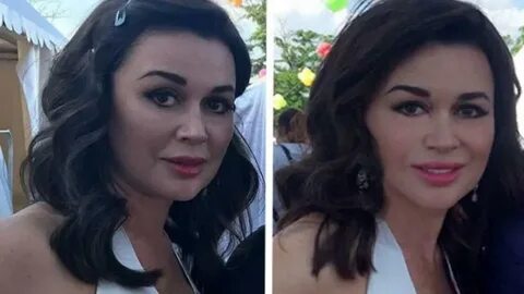 Заворотнюк до и после пластики
