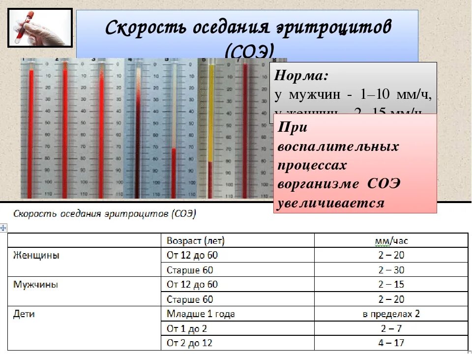 Соэ 37 у женщины что. Соэ норма у мужчин. показатель соэ в анализе крови норма для женщин. соэ 24 мм/ч у мужчин. соэ 7 у мужчин.