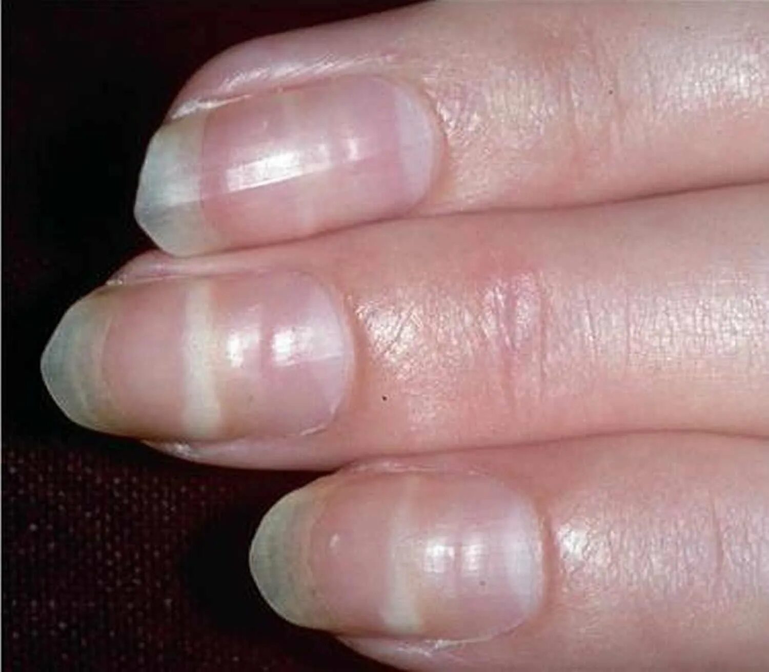Лейконихия продольная. Лейконихия (белые пятнышки). Поперечные полосы на ногтях рук.