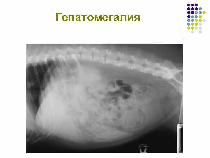 Гепатомегалия печени и поджелудочной железы что это. Гепатомегалия. Гепатомегалия рентген. Гепатомегалия УЗИ фото.