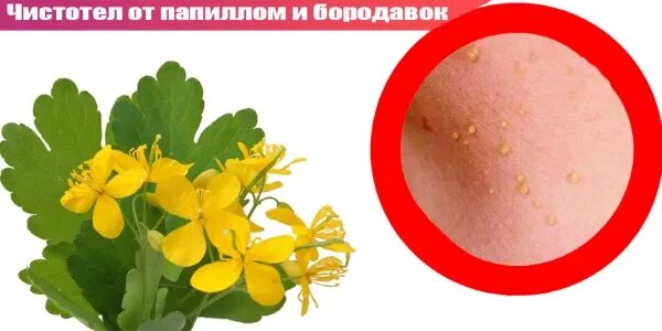 Что удаляют чистотелом. Что удаляют чистотелом