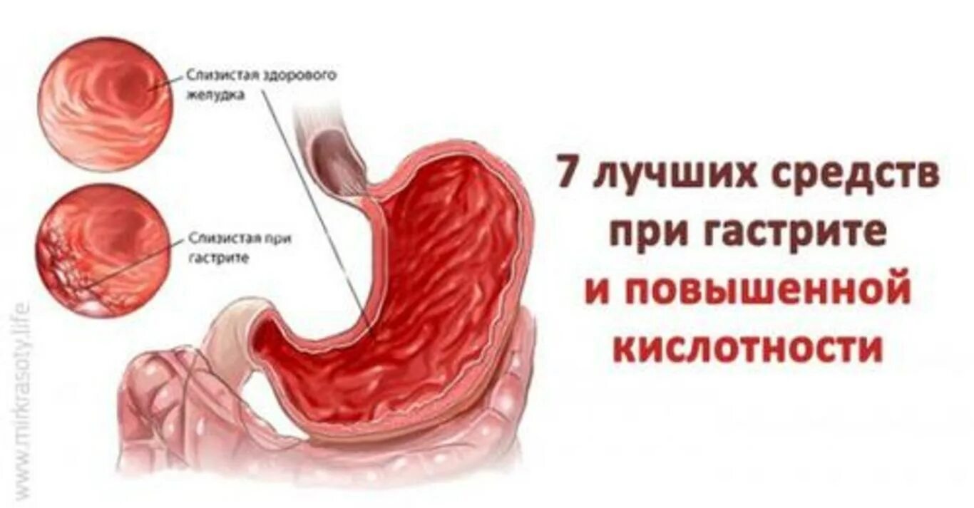 Боли в желудке кислотность. Желудок с повышенной кислотностью. Повышенное кислотообразование в желудке. Повышенная кислотность желудка. Гастрит повышенная кислотность.