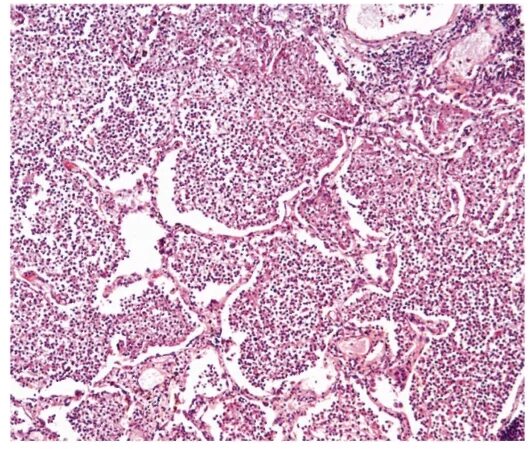 Пневмония гистология. Гнойно геморрагическая пневмония микропрепарат. Геморрагическая пневмония гистология. Крупозная пневмония гистология. Пневмония гистология.