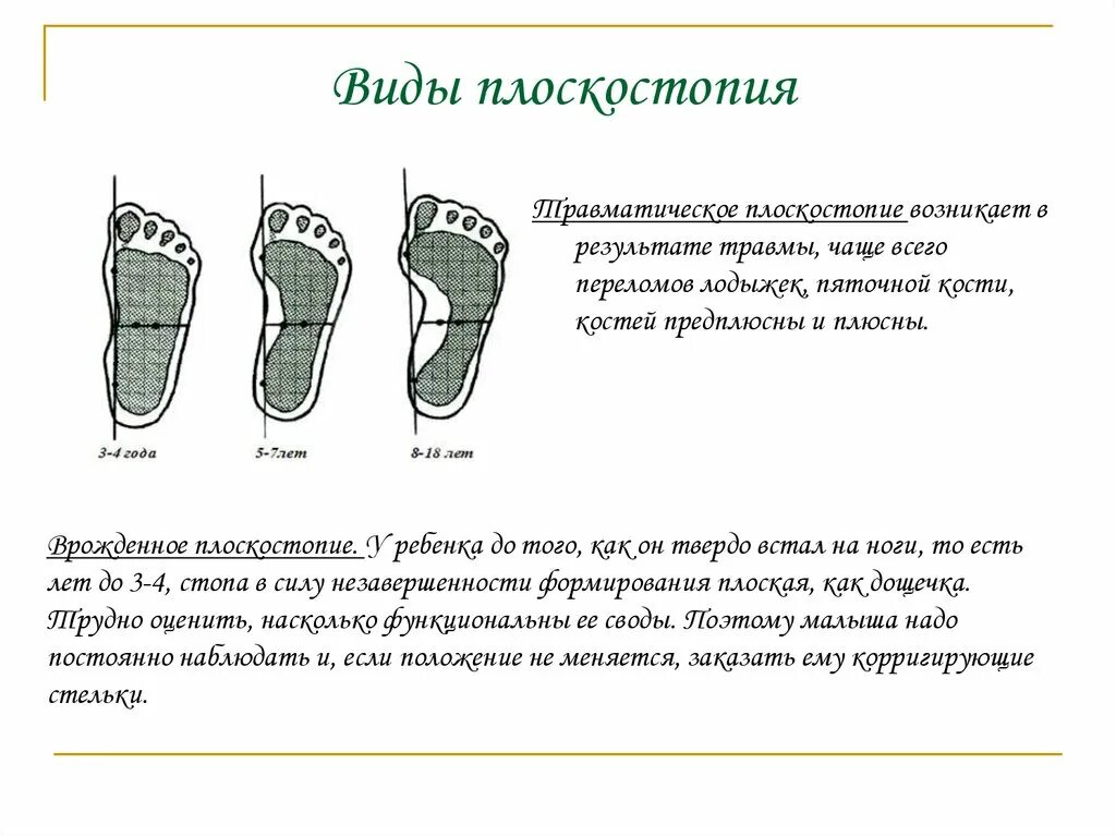 Виды плоскостопия у детей