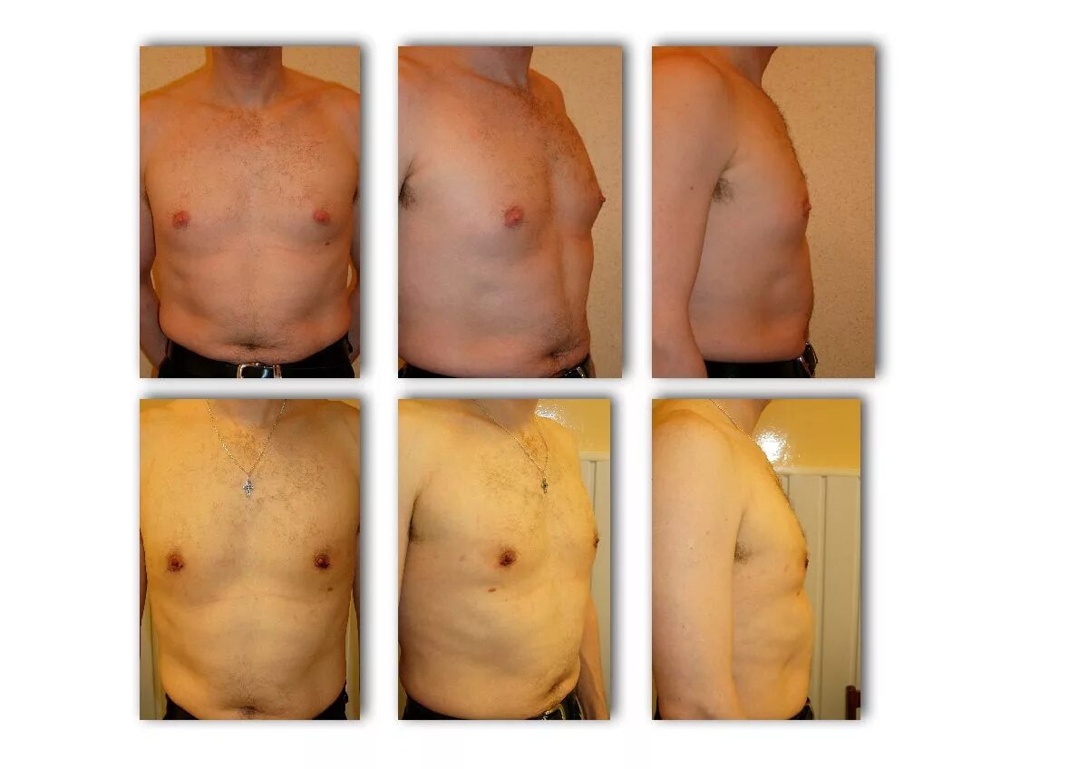 Гинекомастия по мкб 10 у мужчин. Гинекомастия как лечить. Милованов гинекомастия. Гинекомастия как лечить. Эстрадиоловая гинекомастия.