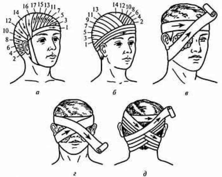 Повязка гиппократа техника наложения