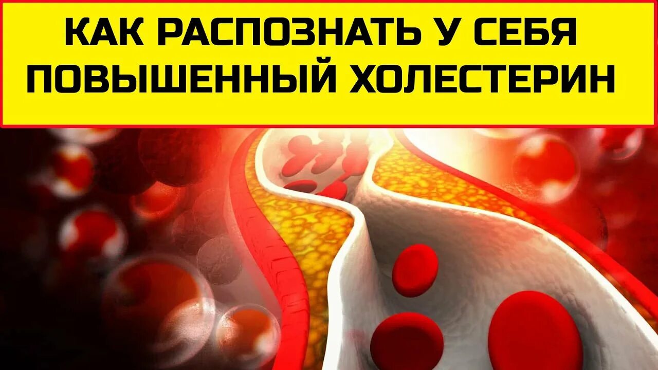 Симптомы повышенного холестерина. Высокий холестерин. Признаки высокого холестерина. Повышение холестерина симптомы. Проявление повышенного холестерина.