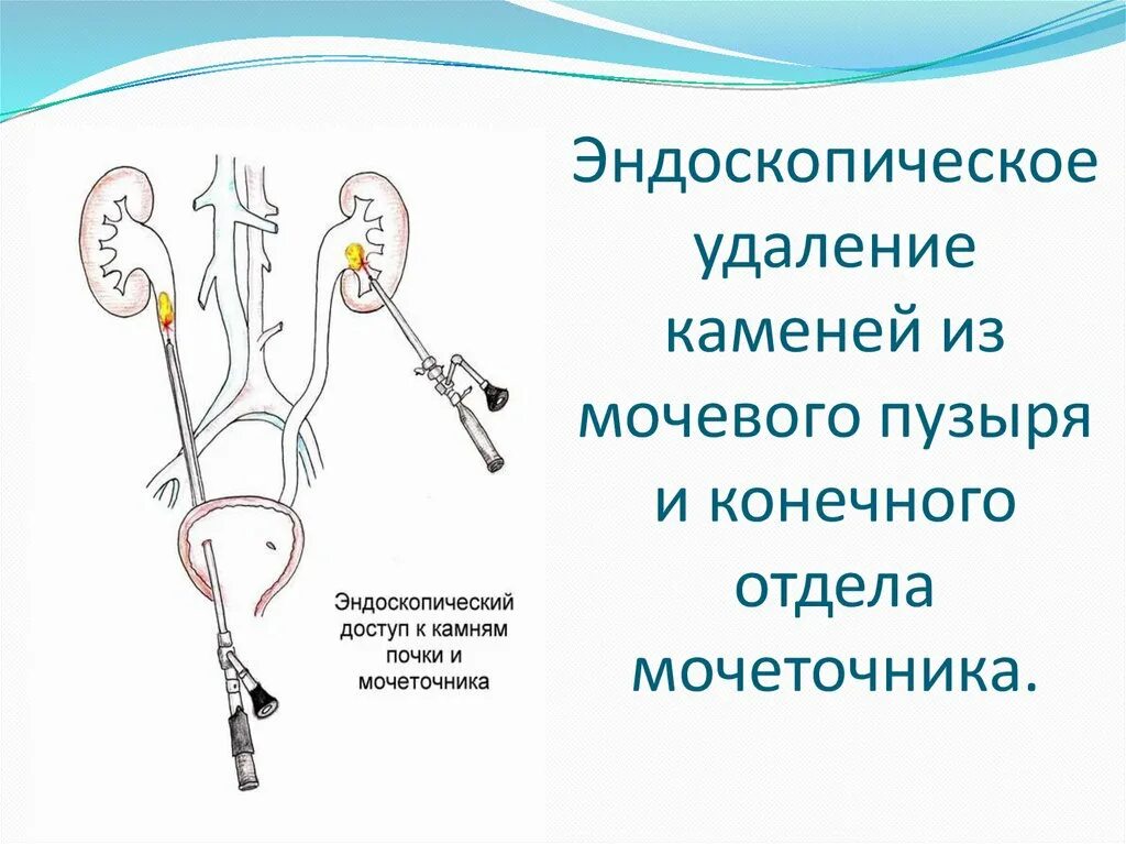 Камень в стенте мочеточника. Эндоскопическая контактная литотрипсия. Эндоскопическая уретеролитотрипсия. Стент внутреннего дренирования почки. Стенд в почке и мочеточнике.