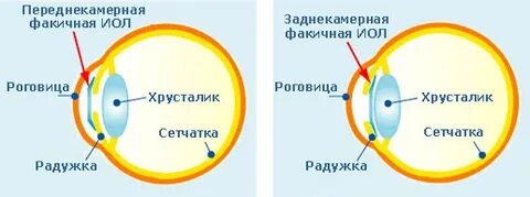 Имплантация линзы отзывы
