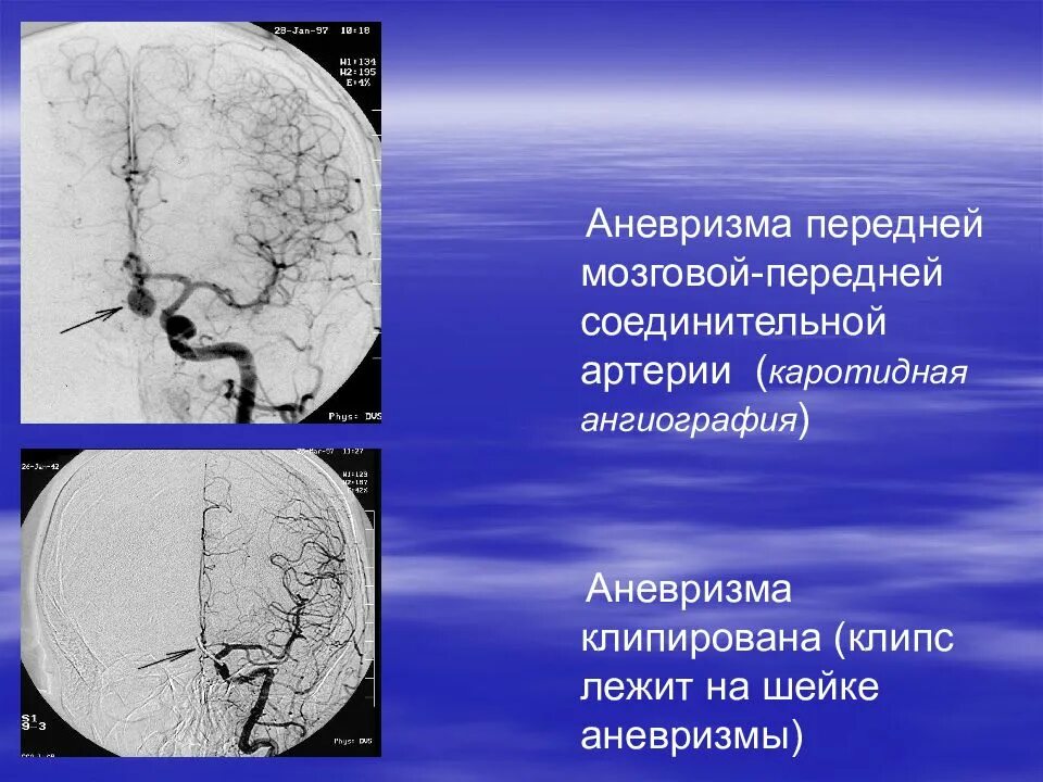 Аневризма артерии головного мозга. Аневризма средней мозговой артерии головного мозга. аневризма мозговых артерий кт. передняя соединительная артерия головного мозга аневризма. аневризма передней мозговой артерии головного мозга.
