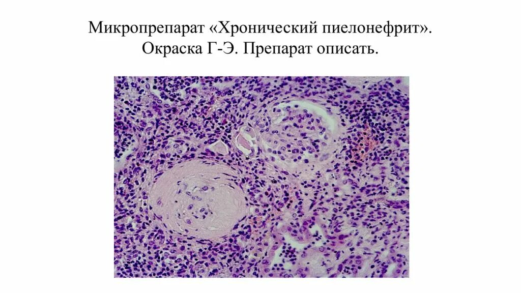 Пиелонефрит микропрепарат. Острый пиелонефрит патанатомия микропрепарат. Хроническая болезнь почек микропрепарат. Хронический пиелонефрит микропрепарат. Хронический пиелонефрит патанатомия.